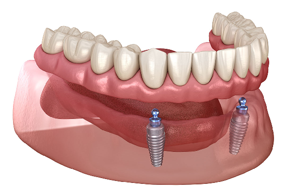 Implant Supported Dentures