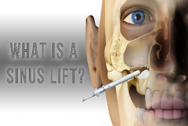 Sinus Lift