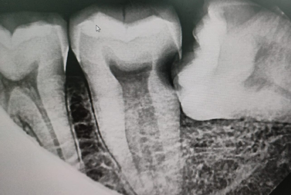 Wisdom Tooth Extraction