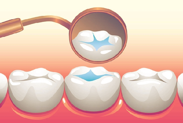 Preventive Sealants