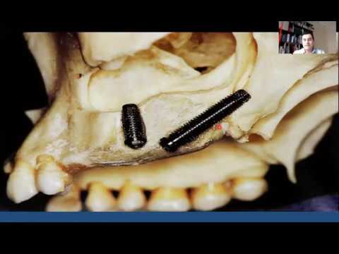 Zygomatic Implants