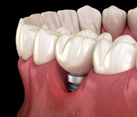 Best Dental Implant Center