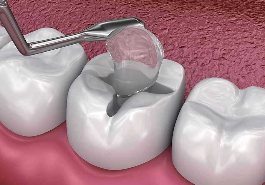 Dental Crown Placement
