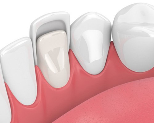 Dental Crown Placement