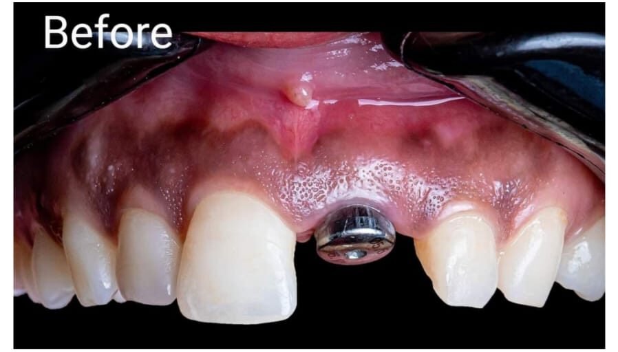 After Dental Implant