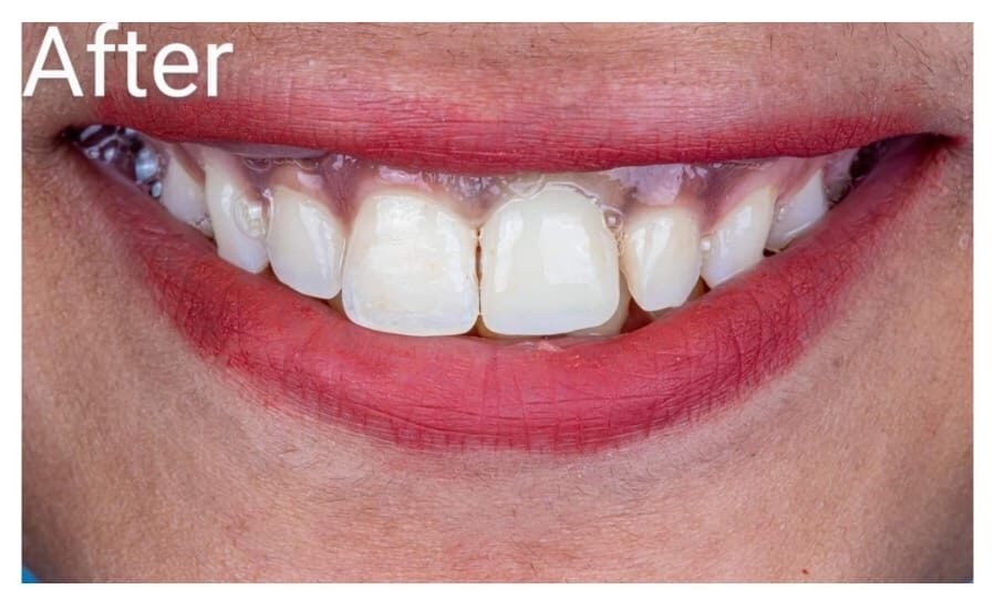 Before Dental Implant