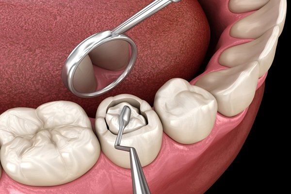 Root Canal Treatment