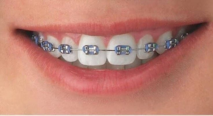 Root Canal Treatment