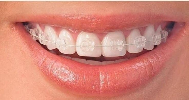 After Dental Implant