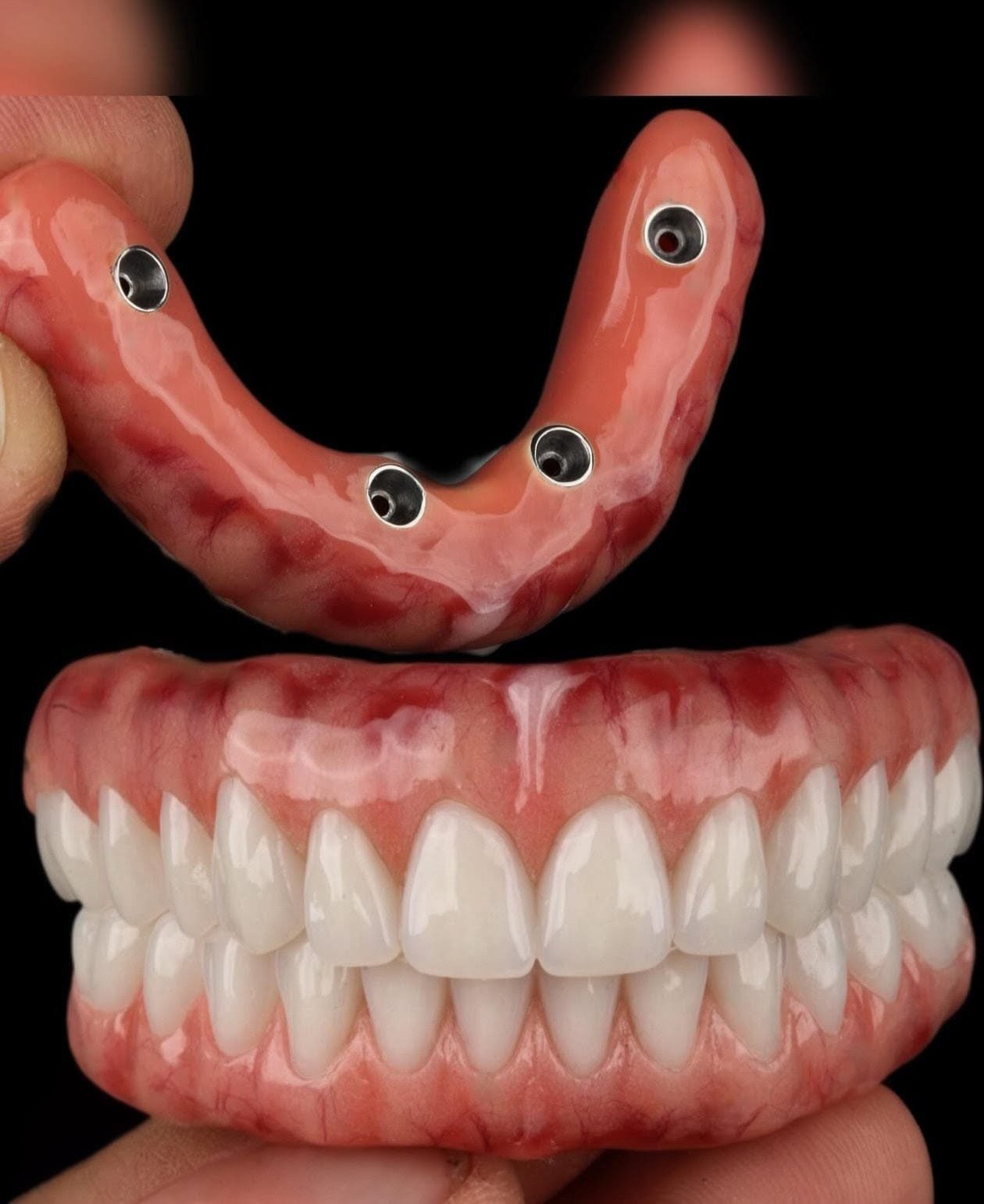 Dental Implant Treatment