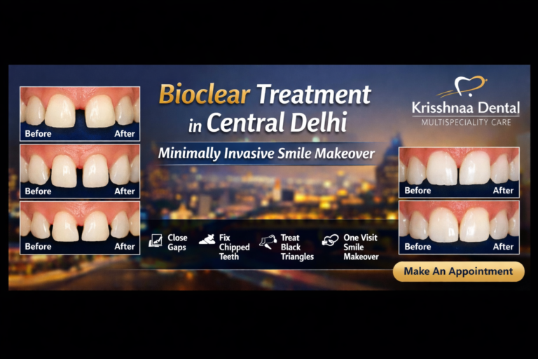 Bioclear treatment in Central Delhi at Krisshnaa Dental Multispeciality Care showing diastema closure, black triangle correction, and minimally invasive smile makeover by expert dentist near me in New Delhi.