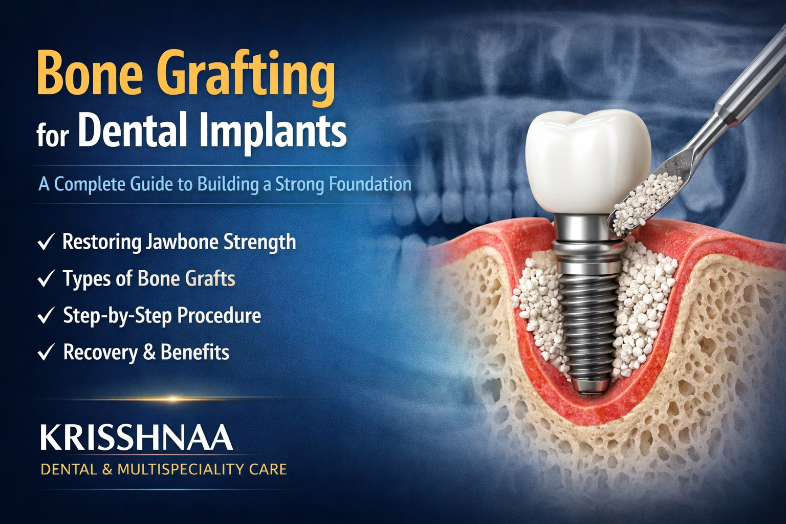 Bone Grafting for Dental Implants: A Complete Guide to Building a Strong Foundation/Bone Grafting for Dental Implants in Central Delhi | Krisshnaa Dental