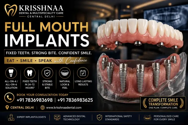 Full mouth dental implants with realistic implant-supported teeth for complete smile restoration at Krisshnaa Dental & Multispeciality Care, Central Delhi.