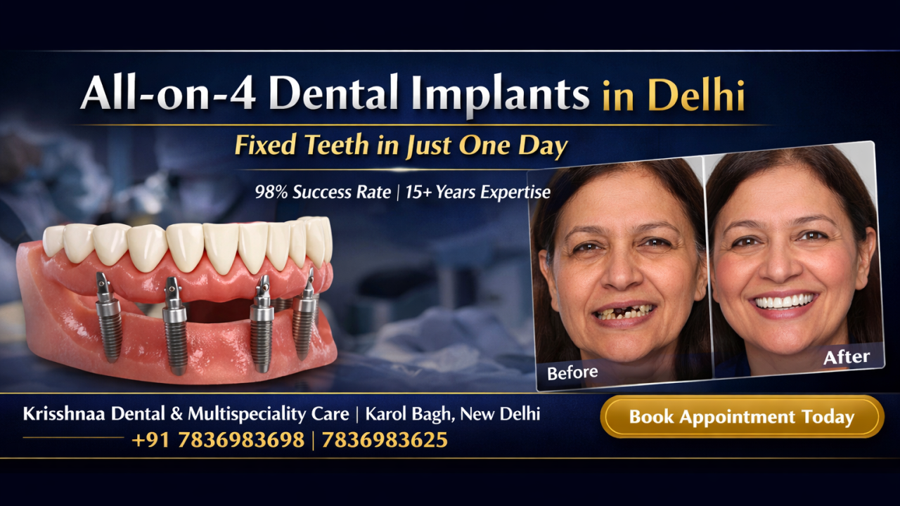 All on 4 dental implants full arch fixed teeth restoration at Krisshnaa Dental Karol Bagh Delhi for NRI patients