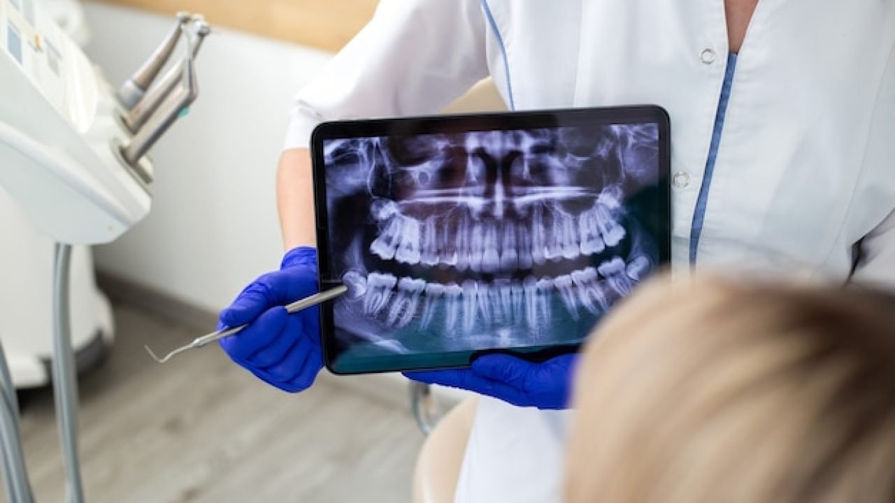 Advanced Zygomatic Implants