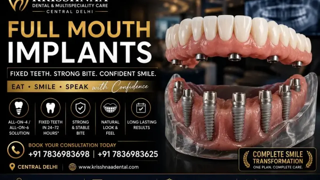 Full mouth dental implants with realistic implant-supported teeth for complete smile restoration at Krisshnaa Dental & Multispeciality Care, Central Delhi.