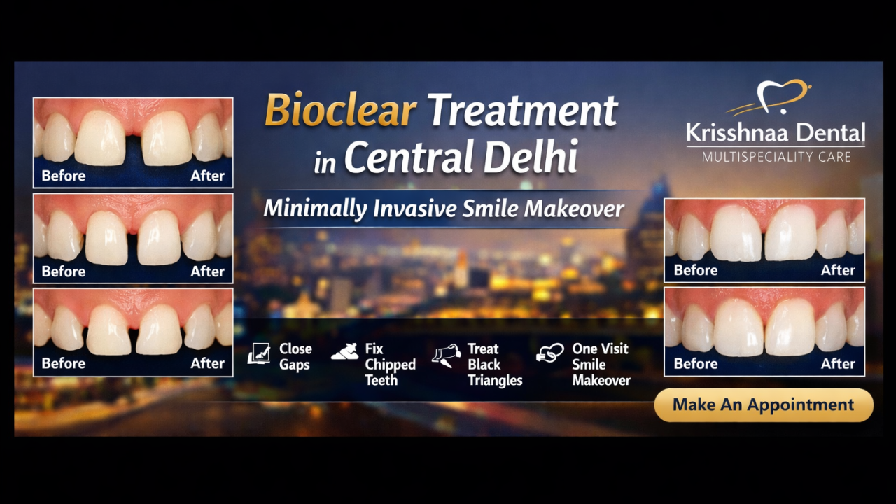 Bioclear treatment in Central Delhi at Krisshnaa Dental Multispeciality Care showing diastema closure, black triangle correction, and minimally invasive smile makeover by expert dentist near me in New Delhi.
